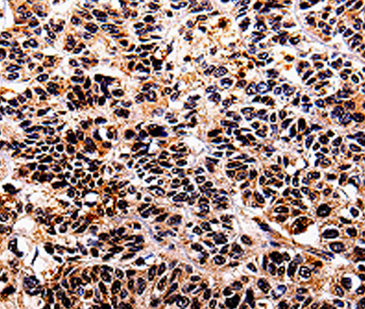 Immunohistochemistry of paraffin-embedded Human lung cancer tissue using IL10RA Polyclonal Antibody at dilution 1:30