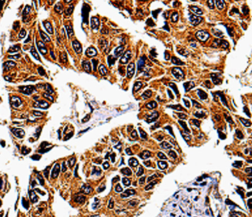 Immunohistochemistry of paraffin-embedded Human lung cancer tissue using IL13RA1 Polyclonal Antibody at dilution 1:50