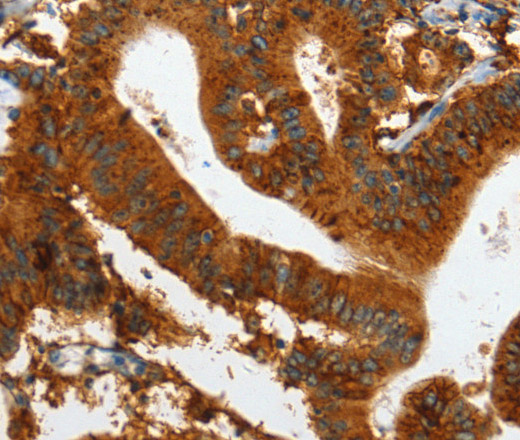 Immunohistochemistry of paraffin-embedded Human colon cancer tissue using IL20RA Polyclonal Antibody at dilution 1:35
