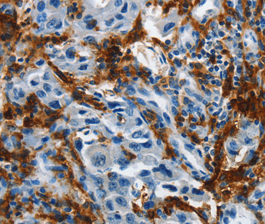 Immunohistochemistry of paraffin-embedded Human lung cancer tissue using IL20RA Polyclonal Antibody at dilution 1:35