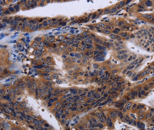 Immunohistochemistry of paraffin-embedded Human gasrtic cancer tissue using HTR2B Polyclonal Antibody at dilution 1:60