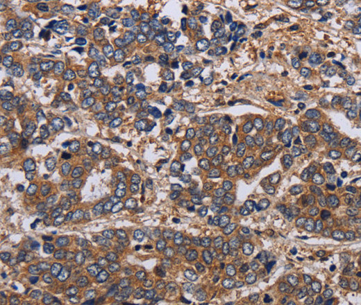 Immunohistochemistry of paraffin-embedded Human liver cancer tissue using HTR2B Polyclonal Antibody at dilution 1:60