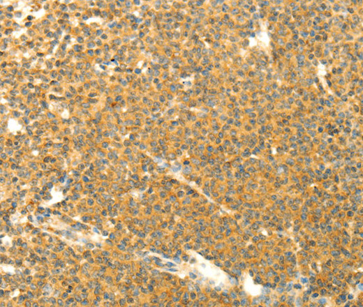 Immunohistochemistry of paraffin-embedded Human lymphoma using AARS2 Polyclonal Antibody at dilution of 1:40