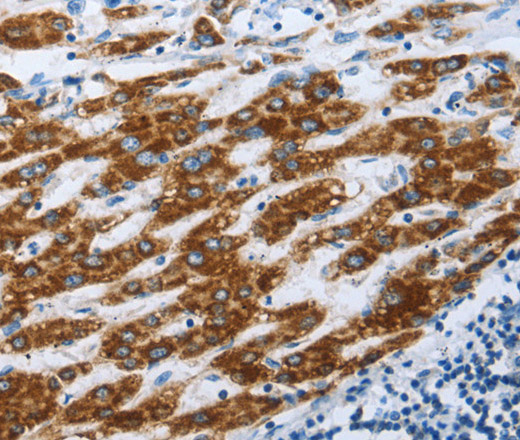 Immunohistochemistry of paraffin-embedded Human liver cancer using AIFM1 Polyclonal Antibody at dilution of 1:30