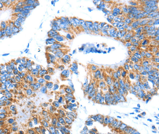 Immunohistochemistry of paraffin-embedded Human colon cancer using AIFM1 Polyclonal Antibody at dilution of 1:30