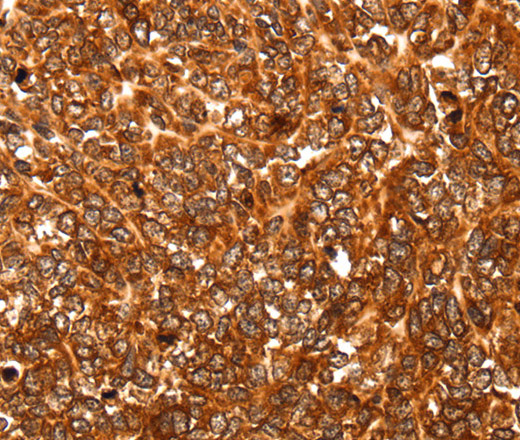 Immunohistochemistry of paraffin-embedded Human ovarian cancer using ALDOA Polyclonal Antibody at dilution of 1:30