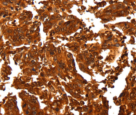 Immunohistochemistry of paraffin-embedded Human gastic cancer using ALDOA Polyclonal Antibody at dilution of 1:30