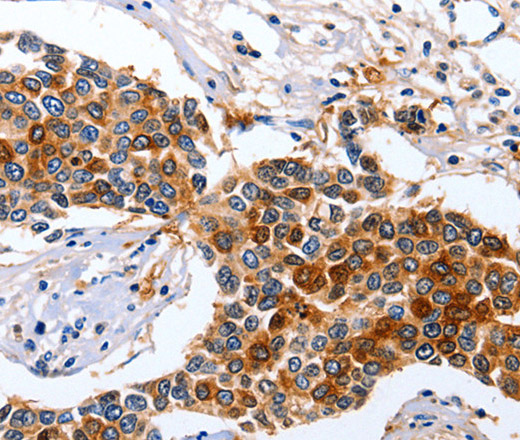 Immunohistochemistry of paraffin-embedded Human breast cancer tissue using GFER Polyclonal Antibody at dilution 1:50