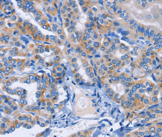 Immunohistochemistry of paraffin-embedded Human thyroid cancer using AMACR Polyclonal Antibody at dilution of 1:30