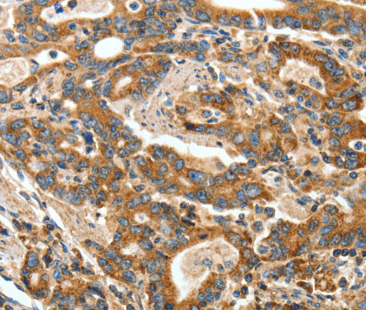 Immunohistochemistry of paraffin-embedded Human gasrtic cancer tissue using ANGPTL1 Polyclonal Antibody at dilution 1:40