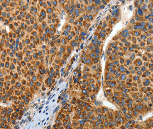 Immunohistochemistry of paraffin-embedded Human liver cancer tissue using ANGPTL1 Polyclonal Antibody at dilution 1:40