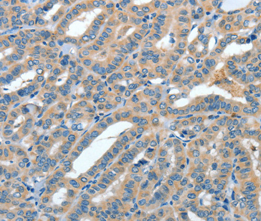 Immunohistochemistry of paraffin-embedded Human thyroid cancer tissue using ANGPT1 Polyclonal Antibody at dilution 1:50