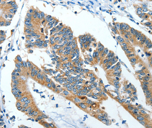 Immunohistochemistry of paraffin-embedded Human colon cancer tissue using ANGPT1 Polyclonal Antibody at dilution 1:50