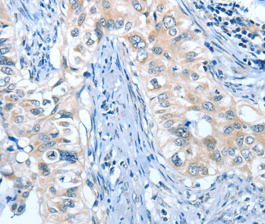 Immunohistochemistry of paraffin-embedded Human cervical cancer using ANGPT2 Polyclonal Antibody at dilution of 1:45