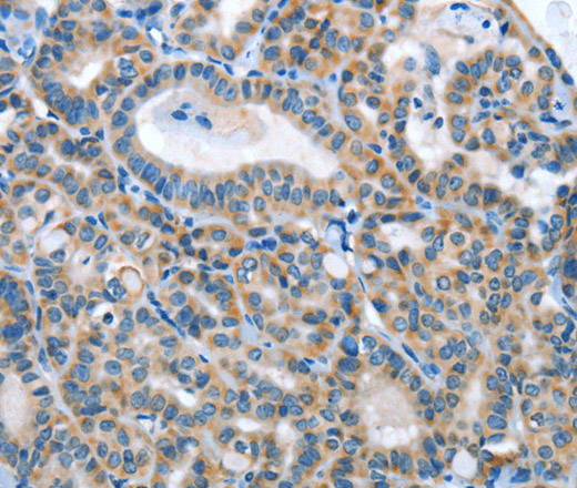 Immunohistochemistry of paraffin-embedded Human thyroid cancer using ANGPT2 Polyclonal Antibody at dilution of 1:45