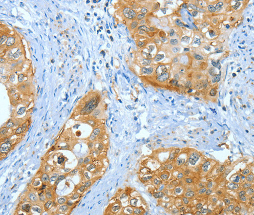 Immunohistochemistry of paraffin-embedded Human cervical cancer using ANXA3 Polyclonal Antibody at dilution of 1:35