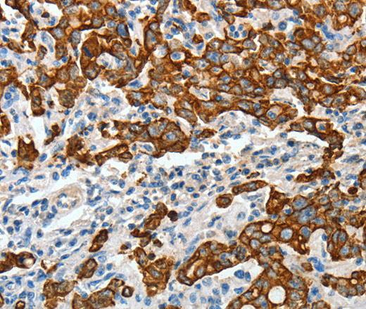 Immunohistochemistry of paraffin-embedded Human gastric cancer tissue using CK-18 Polyclonal Antibody at dilution 1:50