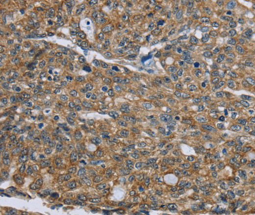 Immunohistochemistry of paraffin-embedded Human ovarian cancer tissue using CK-5 Polyclonal Antibody at dilution 1:30