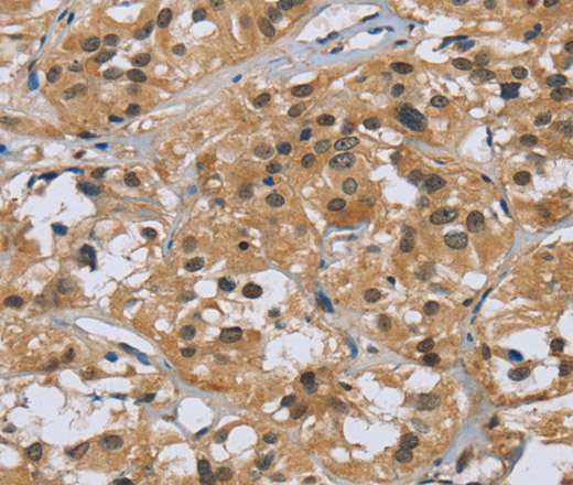 Immunohistochemistry of paraffin-embedded Human thyroid cancer tissue using CK-5 Polyclonal Antibody at dilution 1:30