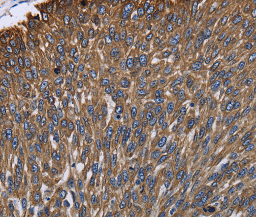 Immunohistochemistry of paraffin-embedded Human lung cancer using KRT31 Polyclonal Antibody at dilution of 1:30