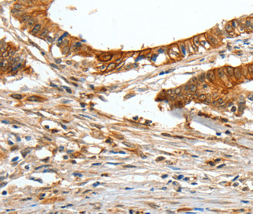 Immunohistochemistry of paraffin-embedded Human colon cancer tissue using COL1A2 Polyclonal Antibody at dilution 1:70