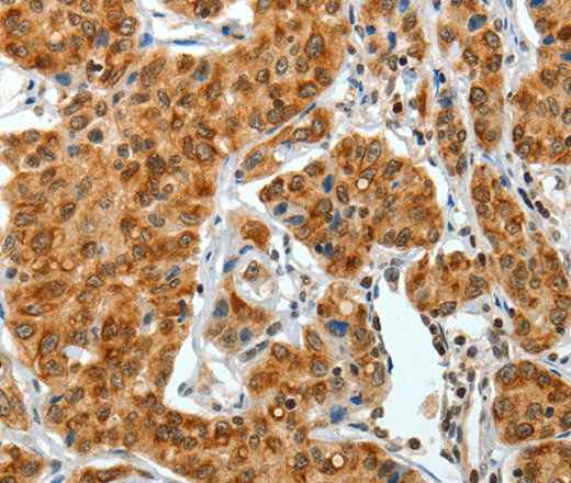 Immunohistochemistry of paraffin-embedded Human lung cancer tissue using COL1A2 Polyclonal Antibody at dilution 1:70