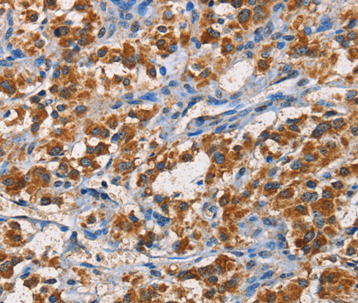 Immunohistochemistry of paraffin-embedded Human thyroid cancer tissue using APLNR Polyclonal Antibody at dilution 1:50