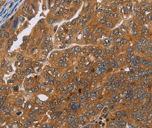 Immunohistochemistry of paraffin-embedded Human ovarian cancer tissue using ADAMTS15 Polyclonal Antibody at dilution 1:40