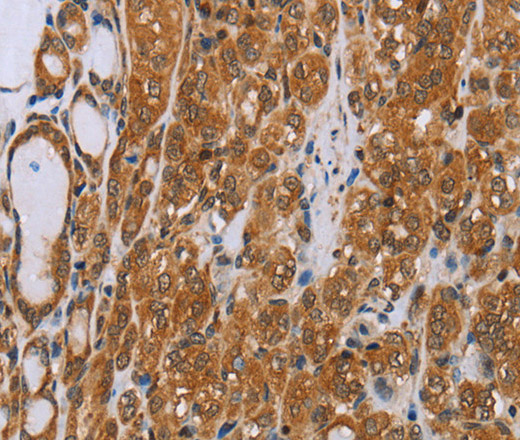 Immunohistochemistry of paraffin-embedded Human thyroid cancer tissue using ADAMTS15 Polyclonal Antibody at dilution 1:40