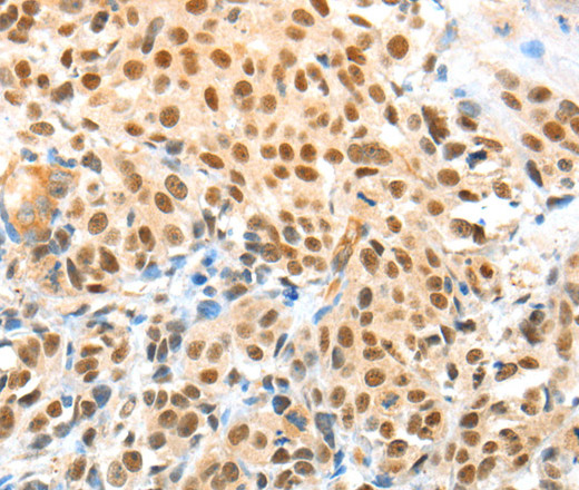 Immunohistochemistry of paraffin-embedded Human esophagus cancer using APPL1 Polyclonal Antibody at dilution of 1:70