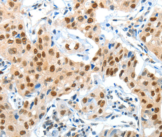 Immunohistochemistry of paraffin-embedded Human lung cancer using APPL1 Polyclonal Antibody at dilution of 1:70