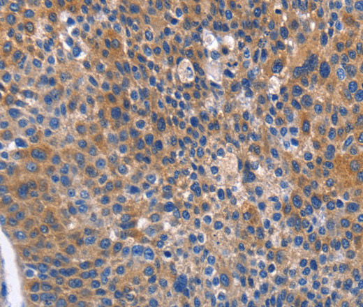 Immunohistochemistry of paraffin-embedded Human liver cancer tissue using ARRB1 Polyclonal Antibody at dilution 1:50