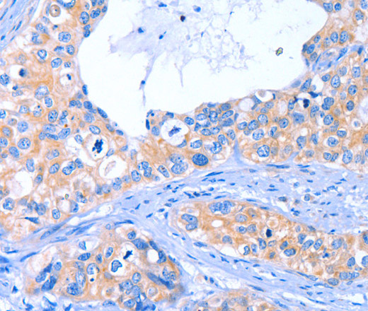 Immunohistochemistry of paraffin-embedded Human cervical cancer tissue using ARRB1 Polyclonal Antibody at dilution 1:50