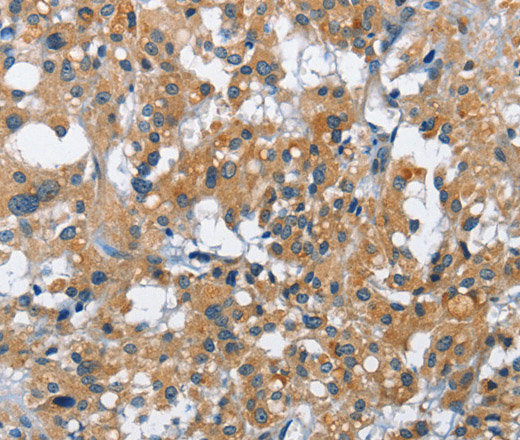 Immunohistochemistry of paraffin-embedded Human thyroid cancer tissue using CREB2 Polyclonal Antibody at dilution 1:40