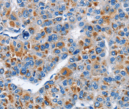 Immunohistochemistry of paraffin-embedded Human liver cancer tissue using CREB2 Polyclonal Antibody at dilution 1:40