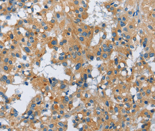 Immunohistochemistry of paraffin-embedded Human thyroid cancer using FGF9 Polyclonal Antibody at dilution of 1:40