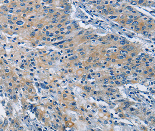 Immunohistochemistry of paraffin-embedded Human gastric cancer tissue using BMPR1B Polyclonal Antibody at dilution 1:30