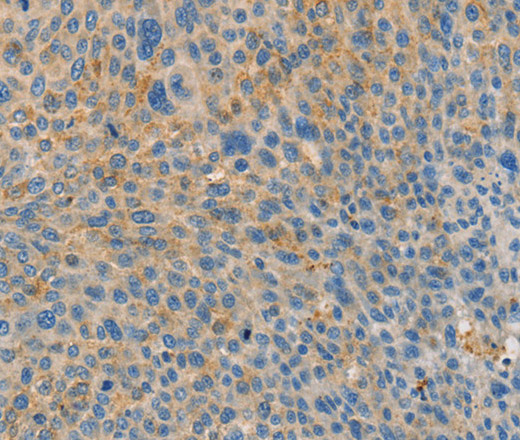 Immunohistochemistry of paraffin-embedded Human liver cancer tissue using BRCA1 Polyclonal Antibody at dilution 1:35