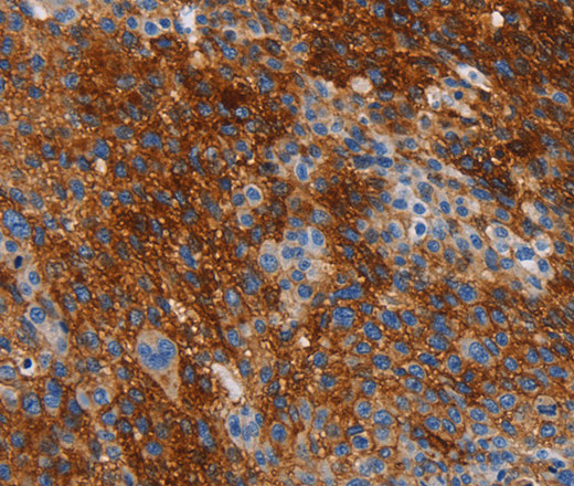 Immunohistochemistry of paraffin-embedded Human liver cancer tissue using CA9 Polyclonal Antibody at dilution 1:50