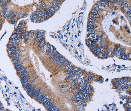 Immunohistochemistry of paraffin-embedded Human colon cancer using CA4 Polyclonal Antibody at dilution of 1:30