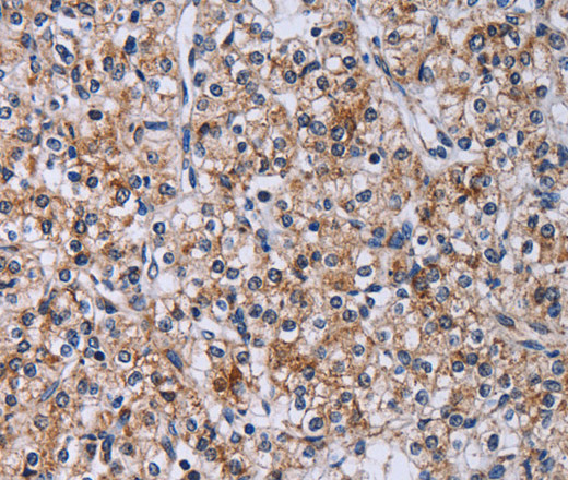 Immunohistochemistry of paraffin-embedded Human prostate cancer using CA4 Polyclonal Antibody at dilution of 1:30