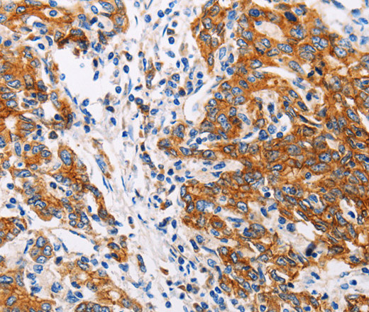 Immunohistochemistry of paraffin-embedded Human gastic cancer using CTNNA1 Polyclonal Antibody at dilution of 1:35