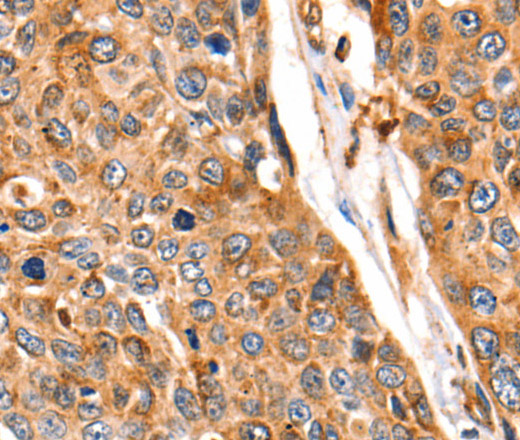 Immunohistochemistry of paraffin-embedded Human esophagus cancer tissue using Cathepsin B Polyclonal Antibody at dilution 1:140