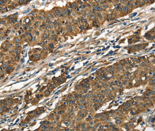 Immunohistochemistry of paraffin-embedded Human gastic cancer using Cathepsin E Polyclonal Antibody at dilution of 1:40