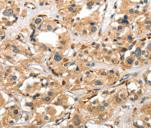 Immunohistochemistry of paraffin-embedded Human thyroid cancer using Cathepsin E Polyclonal Antibody at dilution of 1:40