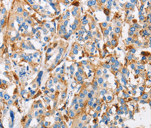 Immunohistochemistry of paraffin-embedded Human esophagus cancer tissue using Cathepsin L Polyclonal Antibody at dilution 1:50