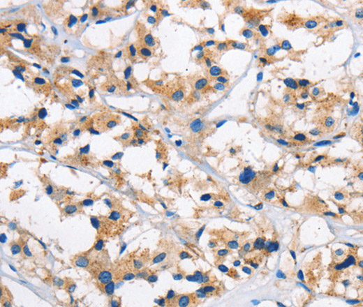 Immunohistochemistry of paraffin-embedded Human thyroid cancer tissue using Cathepsin L Polyclonal Antibody at dilution 1:50