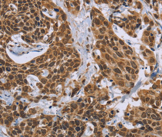 Immunohistochemistry of paraffin-embedded Human cervical cancer tissue using CCL21 Polyclonal Antibody at dilution 1:40