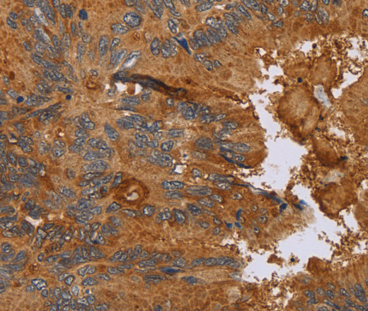 Immunohistochemistry of paraffin-embedded Human colon cancer tissue using CCL21 Polyclonal Antibody at dilution 1:40