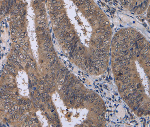 Immunohistochemistry of paraffin-embedded Human colon cancer using CDK5 Polyclonal Antibody at dilution of 1:30